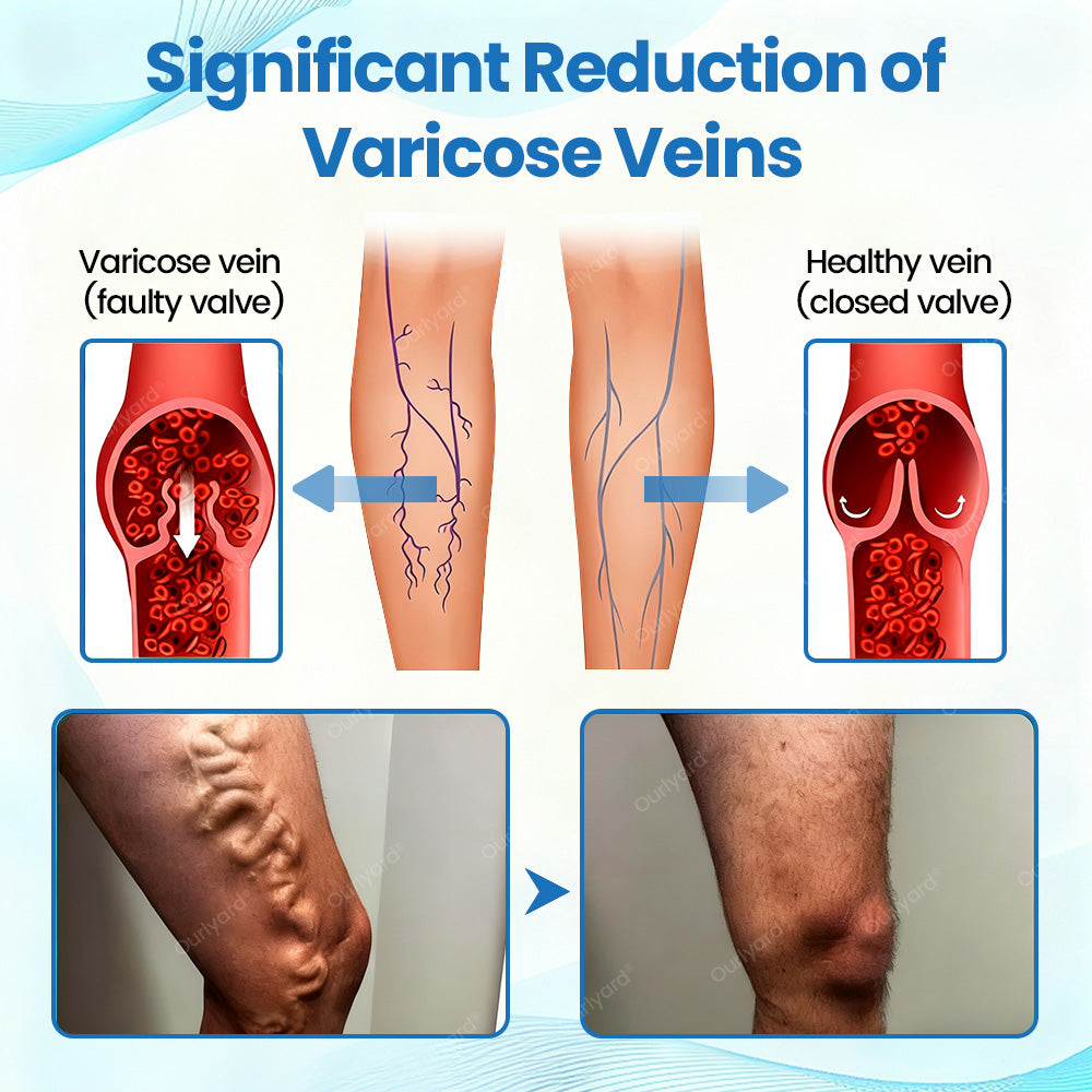 ✅Ourlyard® VascuCare Vein Healing Spray(Designed for Varicose veins, Spider veins, Deep vein Thrombosis, Chronic venous insufficiency, Venous ulcers, Thrombophlebitis and other venous issues)