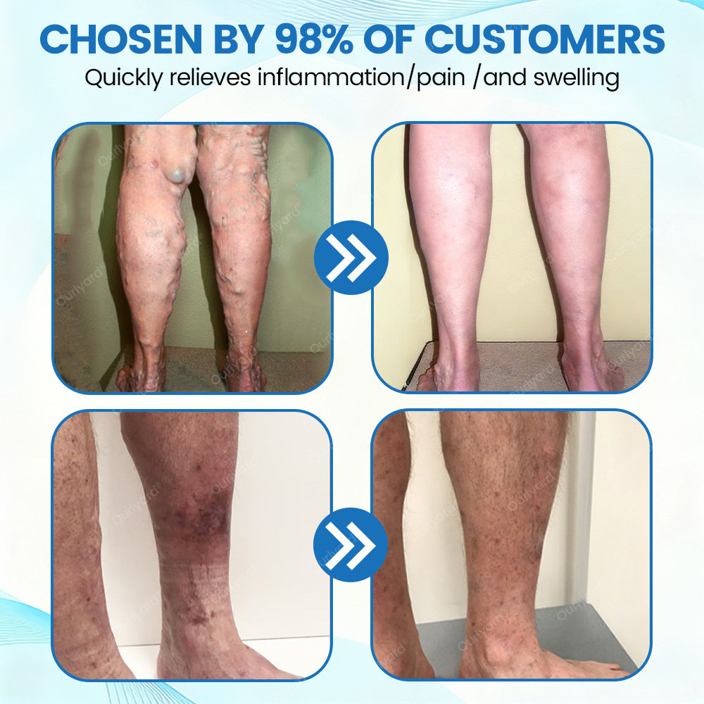 ✅Ourlyard® VascuCare Vein Healing Spray(Designed for Varicose veins, Spider veins, Deep vein Thrombosis, Chronic venous insufficiency, Venous ulcers, Thrombophlebitis and other venous issues)