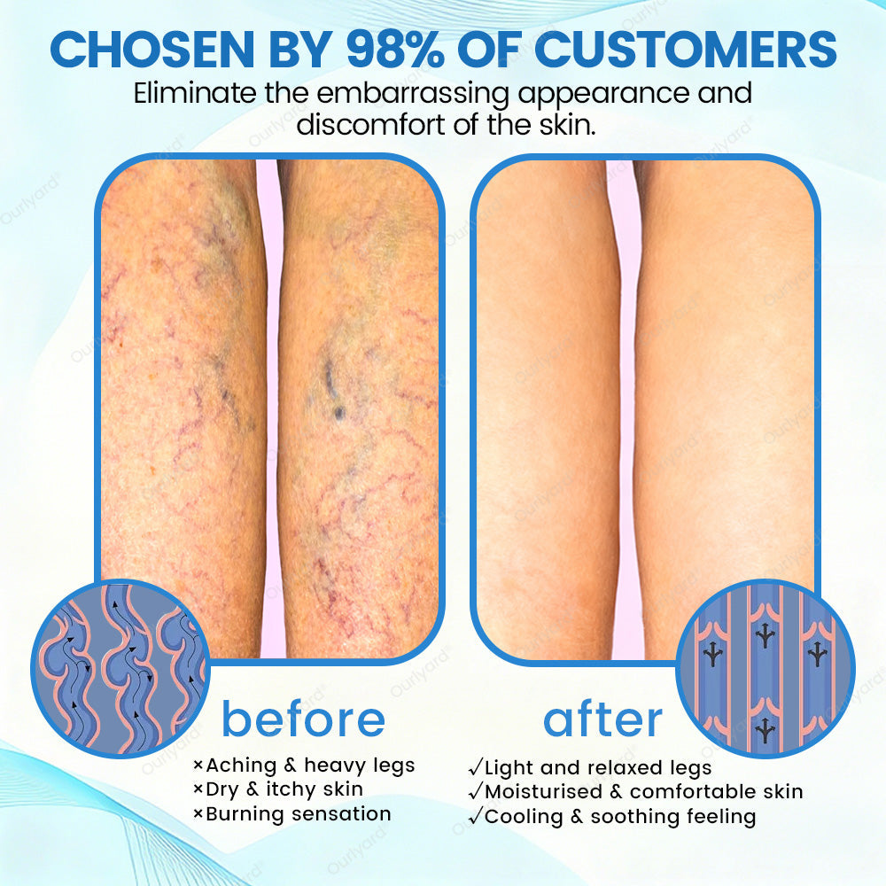 ✅Ourlyard® VascuCare Vein Healing Spray(Designed for Varicose veins, Spider veins, Deep vein Thrombosis, Chronic venous insufficiency, Venous ulcers, Thrombophlebitis and other venous issues)