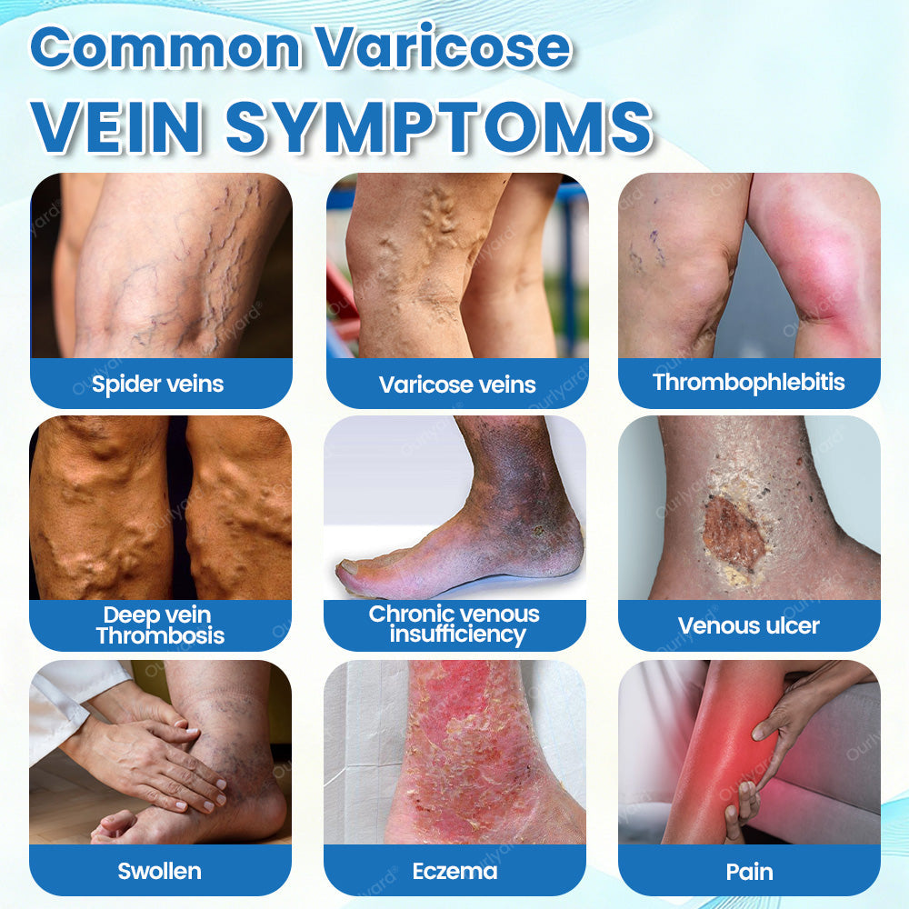 ✅Ourlyard® VascuCare Vein Healing Spray(Designed for Varicose veins, Spider veins, Deep vein Thrombosis, Chronic venous insufficiency, Venous ulcers, Thrombophlebitis and other venous issues)