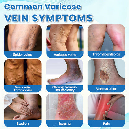 ✅Ourlyard® VascuCare Vein Healing Spray(Designed for Varicose veins, Spider veins, Deep vein Thrombosis, Chronic venous insufficiency, Venous ulcers, Thrombophlebitis and other venous issues)