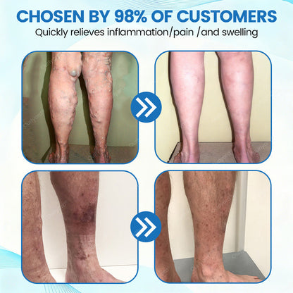 ✅Ourlyard® VascuCare Vein Healing Spray(Designed for Varicose veins, Spider veins, Deep vein Thrombosis, Chronic venous insufficiency, Venous ulcers, Thrombophlebitis and other venous issues)