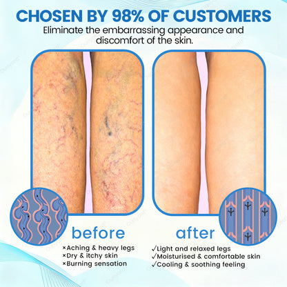 ✅Ourlyard® VascuCare Vein Healing Spray(Designed for Varicose veins, Spider veins, Deep vein Thrombosis, Chronic venous insufficiency, Venous ulcers, Thrombophlebitis and other venous issues)